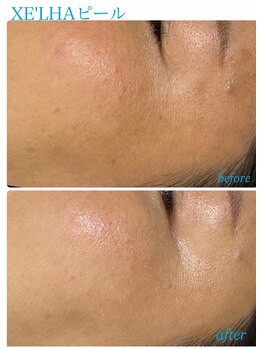 プレジール(Plaisir)/韓国人気No. 1 XE'LHAセラピール