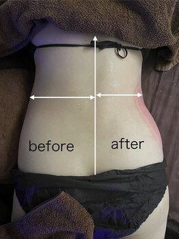 ヨロン(YORON)/脂肪冷却キャビテーション