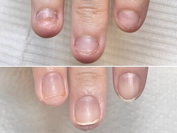 グラシュータン(gracieux temps)/深爪矯正