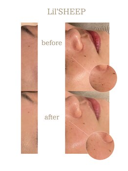 リルシープ(LIL'SHEEP)/エクソソームハーブピーリング