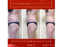 結果だし脂肪分解、キャビテーションのセットの価格です