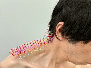 とだ鍼灸院の写真/《深部まで刺すけど痛気持ちイイ!トリガーP鍼》仕事に集中できない程の強い首肩の痛み/コリ/頭痛を解消◎