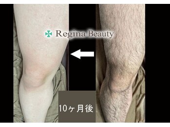 レジーナビューティー(Regina Beauty)/JESA認定脱毛士が丁寧に施術◎