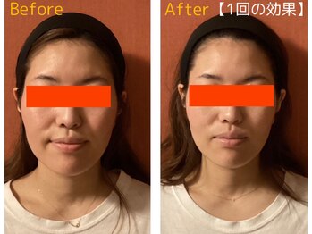 ロイヤリティ(ROYALTY)/左右差、頬のお肉にアプローチ☆