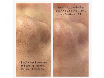 クリエイト(Create)/洗浄機ではできない黒ずみ改善