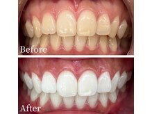 ホワイト 福岡博多店(WHITE)/ホワイトニング通い放題ビフォー