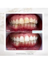 ホワイトニングサロン 名古屋駅店/【ホワイトニング施術例】