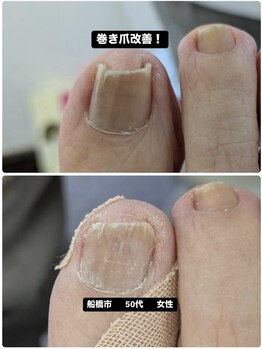 重いの巻き爪の痛みが改善！