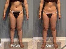 シャイニーシャイニー 金沢店(SHINY/SHINY)/スリムムーヴ痩身症例