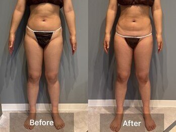 シャイニーシャイニー 金沢店(SHINY/SHINY)/スリムムーヴ痩身症例