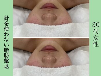 ソルニス(Solnis.)/小顔☆脂肪分解/ハイパーナイフ