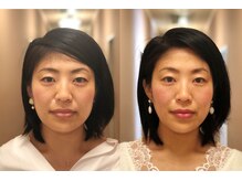 アザブハリーク(AZABU HARIEQ)/症例写真 40代女性（4回施術）