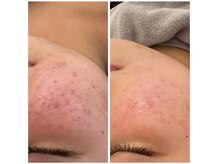 グランデ(Grande)/プラズマでアクネ菌殺菌◎