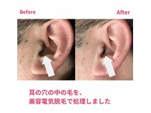 アールプラスラボ(R+labo)/美容電気脱毛のこれがすごい！