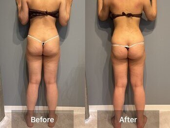 シャイニーシャイニー 金沢店(SHINY/SHINY)/スリムムーヴ痩身症例