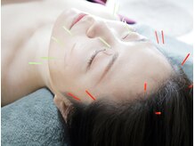 ハリティブ(HARITIVE)の雰囲気（美容鍼でホウレイ線/たるみ/肌荒れ/眼精疲労/肩コリ頭痛を改善！）
