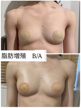 ミセルビューティー 御堂筋本町(micell beauty)/脂肪増殖