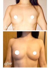 スマイルクルー(SmileClue)/デコルテ削げからの変化