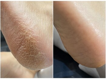 リコロン 銀座(Re:)の写真/大人の身だしなみフットケア★硬い/分厚い/ヒビ割れ/ガサガサかかともお任せ[選べる4種の香りフットバス付]