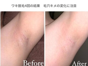 アンシャンテ 芦屋店/芦屋 西宮で美肌脱毛・ワキ脱毛
