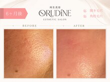 オルディーネ(ORUDiNE)/ 開き毛穴引き締め