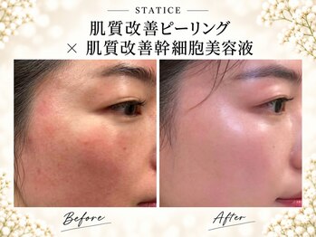 スターティス 麻布十番店(STATICE)の写真/【限定モニター募集中】肌の深部に届く韓国式最新導入機器で「短期集中ケア」が叶う◎