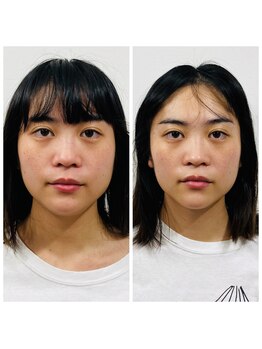 ブランソワン/beforeafter