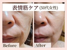 ラーナ(Lana)/リフトアップEMS　BIFORE→AFTER