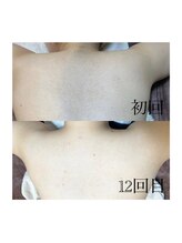 おうちサロン しゅろ/背中の脱毛