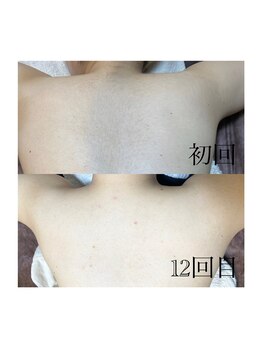 おうちサロン しゅろ/背中の脱毛