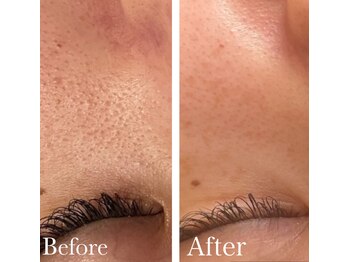 MMK/毛穴スッキリつるん肌