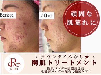 ホワイトアクア 四日市店(WHITE AQUA)/頑固なニキビケアも改善へ