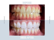 アイリー ホワイトニング 天王寺