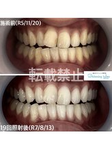 ホワイトニングサロン 福岡天神店/ホワイトニング