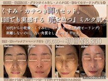 ボディリカバリー(Bodyリカバリー)の雰囲気（話題のミルクピール(乳酸ピーリング)で肌質改善！）