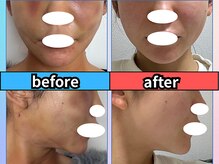 新宿術後インディバサロン【看護師監修/インディバ/ダウンタイムケア/都度払い】の雰囲気（【顔しぼう吸引】出血/硬さ/むくみ/ダウンタイム縮小）