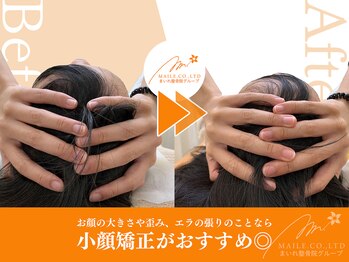 まいれ鍼灸整骨院 整体院 長浜院/小顔矯正ビフォーアフター