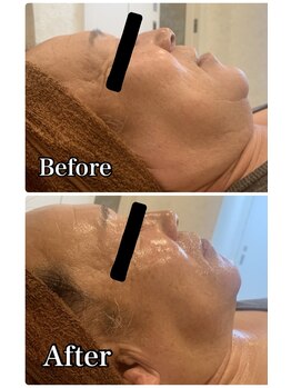 ブランシュール/炭酸カーボキシー×小顔タイト