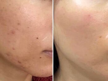 ココ 茅ヶ崎店(Coco)の写真/【最新フェイシャル/圧倒的な浸透再生力】プラズママイクロニードルで最高峰の肌質改善を♪