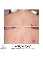 アクシア ビューティー サロン(AXSIA)/【ハーブピーリング】