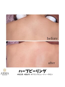 アクシア ビューティー サロン(AXSIA)/【ハーブピーリング】