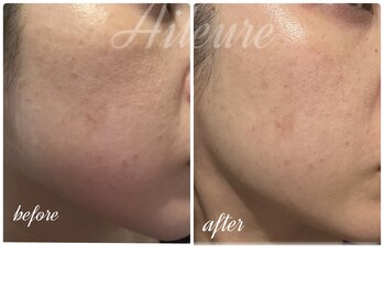 エルール トータルビューティ(Aileure total beauty)/最新ピーリング　ララピール