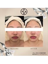 バイオ スキン プラス(Bio Skin Plus)/新潟初導入！プラピール