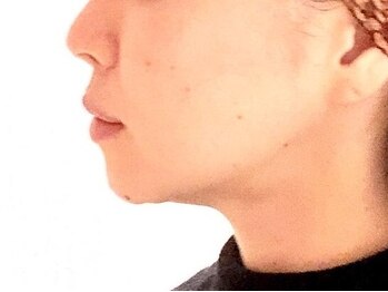 エミリー 守山店(EMILY)の写真/小顔になりたい方必見◎スッキリとしたフェイスラインを導きます！お肌のお悩みにも効果★