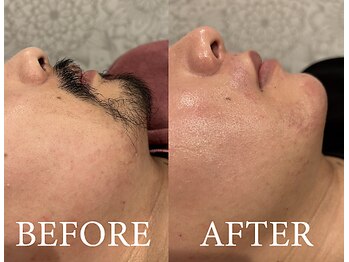 ラヴァコケット 長堀橋店(Lova'coquette)/ワックス髭脱毛【メンズ】