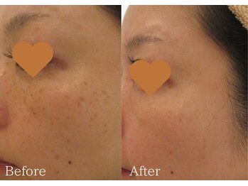 綺麗サロン 脱毛アンドフェイシャル ジュエル(Jewel)/【ポイントシミケア】