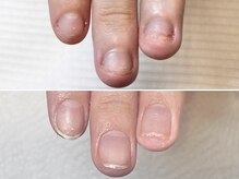 グラシュータン(gracieux temps)/深爪矯正