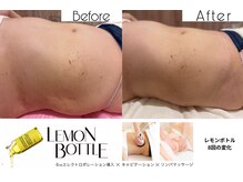 クリニカルエステ イーズ 小倉リバーウォーク北九州デコシティ店/BODYレモンボトル変化写真-5