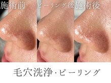レイミー(reimee)/【毛穴洗浄・ピーリング】施術