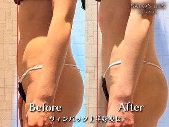 サロン ド エス アオヤマ(SALON DE S AOYAMA)の写真/青山・外苑前の痩身エステ。ウィンバックBACK4の深部加温で、お腹の浮き輪肉やセルライトを解消。